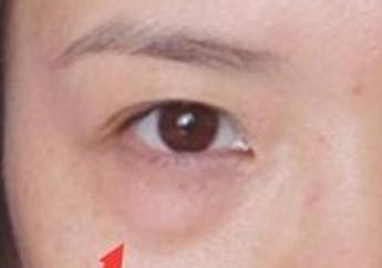 激光去眼袋的效果怎么樣？激光去眼袋注意事項有哪些？
