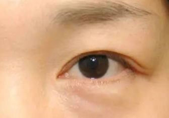 激光去眼袋術(shù)后會不會反彈？激光去眼袋術(shù)后注意事項？