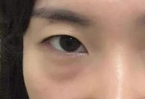 激光去眼袋有什么危害？激光去眼袋幾天能消腫？
