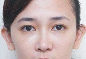激光去眼袋后要休息多久呢？激光去眼袋會很痛嗎？