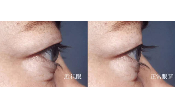 眼球突出矯正術(shù)安全嗎?術(shù)后會不會復發(fā)?