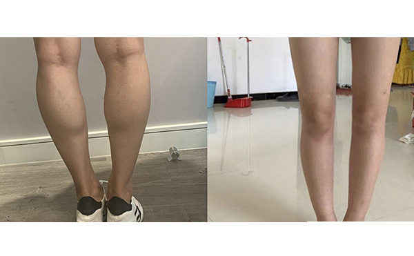 瘦腿針和吸脂哪個(gè)好？