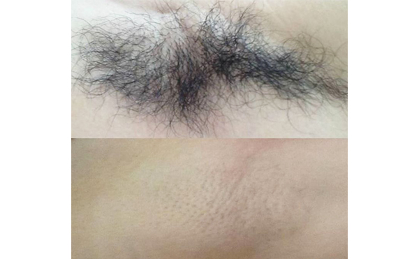 激光脫腋毛疼嗎？