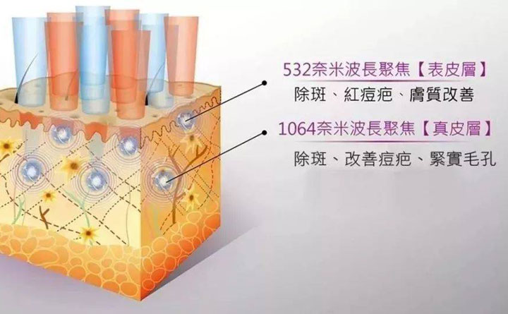 皮秒祛斑恢復(fù)期多久？