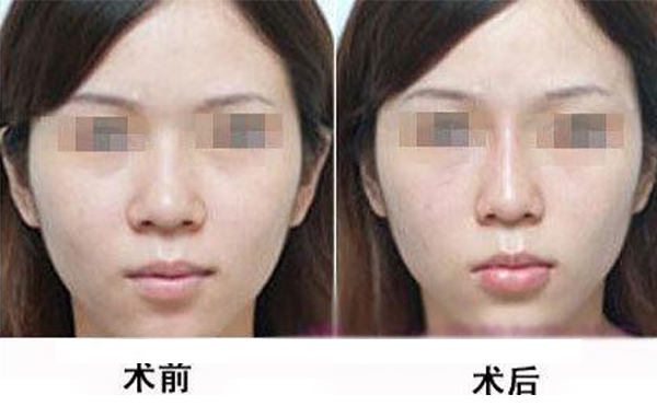鼻頭縮小手術(shù)是怎么做的？術(shù)后應(yīng)該怎么護理