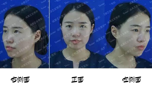 福州名韓整形改善蒜頭鼻大概要花多少錢？