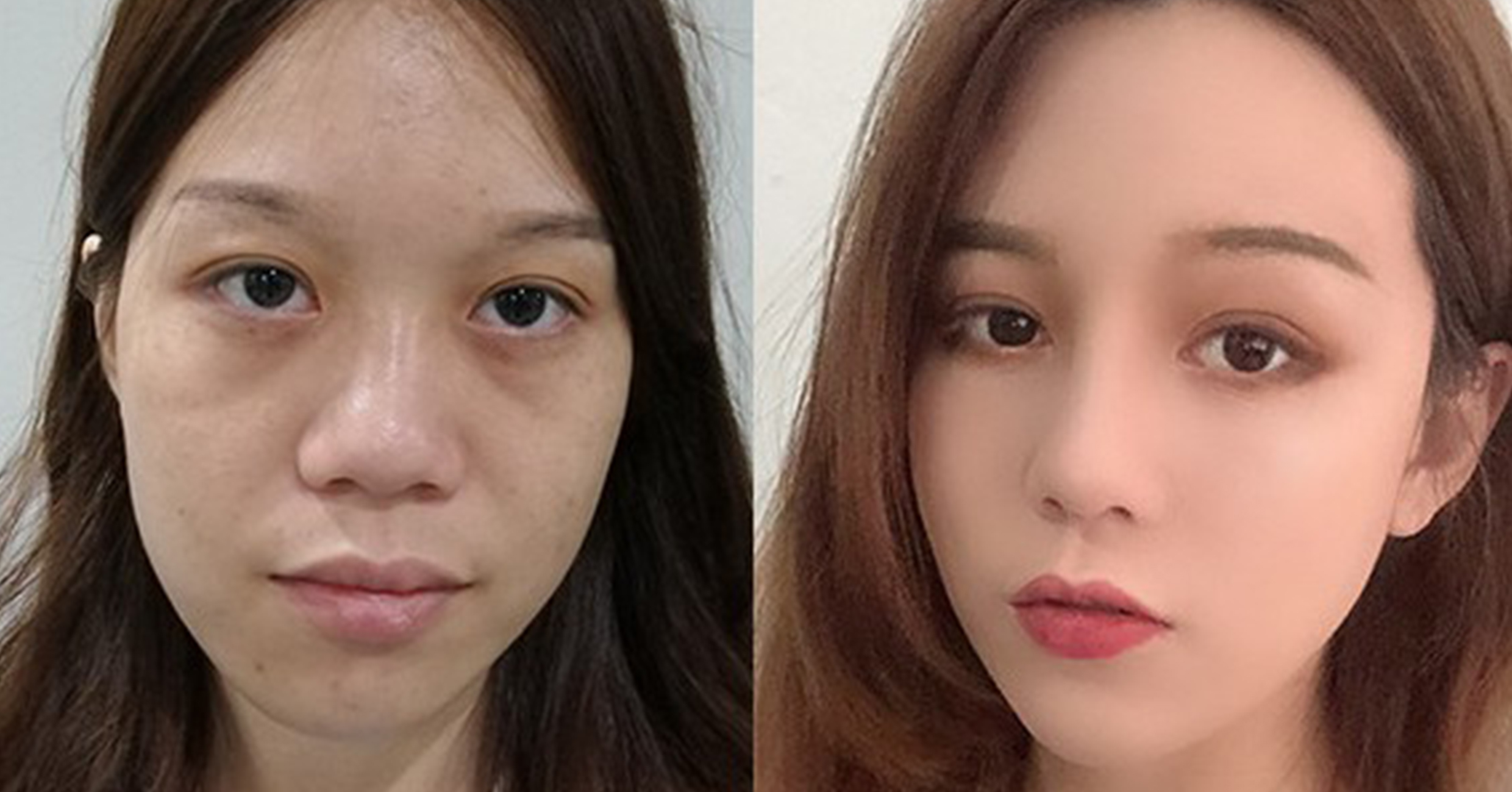 脂肪填充手術效果對比2