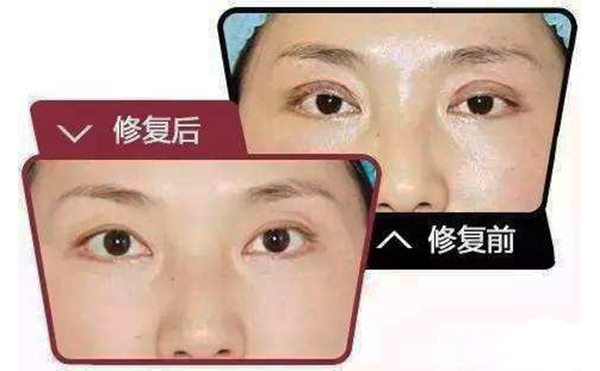 哪些情況需做雙眼皮修復？修復難度大不大?