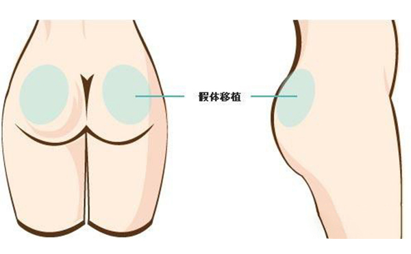 假體豐臀有副作用嗎?術(shù)后會不會留疤?