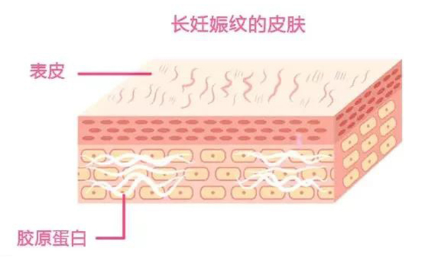 妊娠紋是怎么形成的？