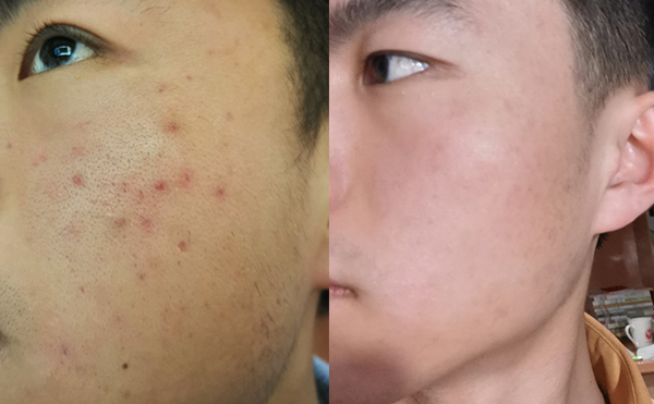 白瓷娃娃每次治療間隔多久？