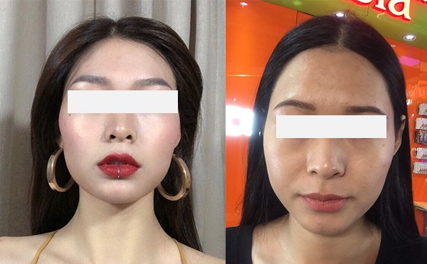 激光脫發(fā)際線效果怎么樣？