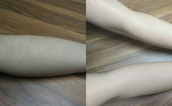 冰點(diǎn)手臂脫毛會(huì)傷害皮膚嗎？