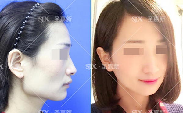 下頜角整形后皮膚是否會(huì)松弛？