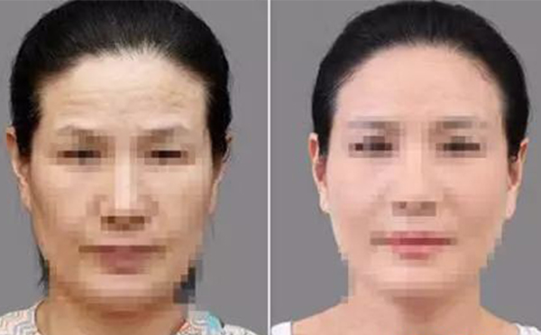 激光除皺有什么優(yōu)勢？