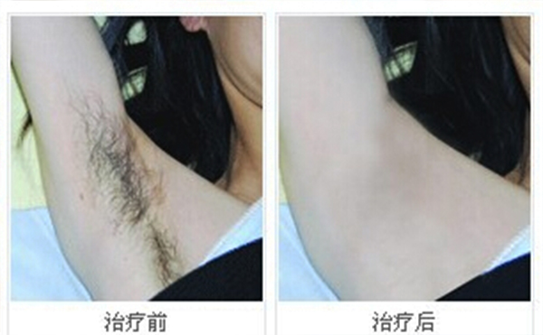 冰點脫腋毛安全嗎？
