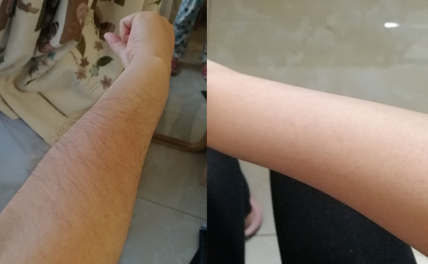 光子手臂脫毛幾次能脫完？