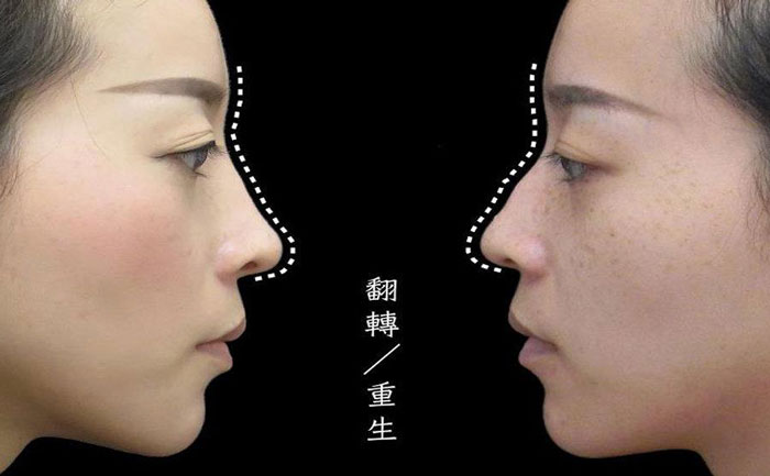 駝峰鼻矯正多少錢？駝峰鼻矯正有危險(xiǎn)嗎？