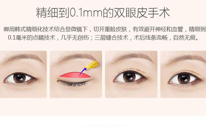 韓式三點(diǎn)雙眼皮一般要多少錢(qián)？