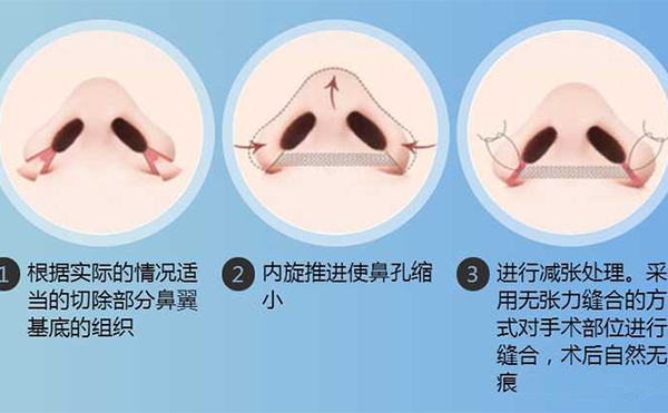 鼻翼縮小手術(shù)有用嗎？