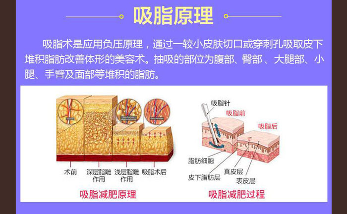 水動力吸脂效果好嗎？