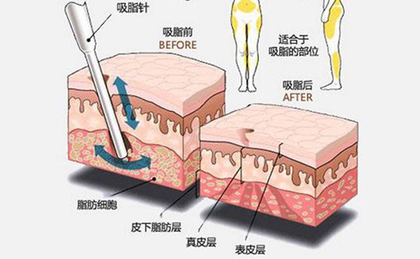 大腿吸脂有什么優(yōu)點？