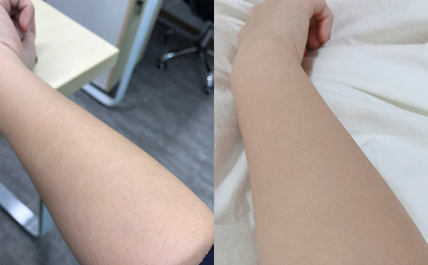冰點脫毛有什么優(yōu)勢？