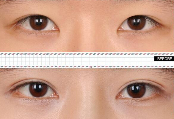 做雙眼皮價格是多少？哪種眼睛適合做雙眼皮呢?
