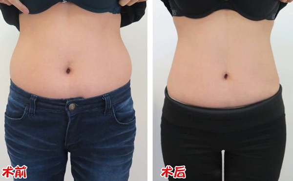 腹部吸脂效果如何？