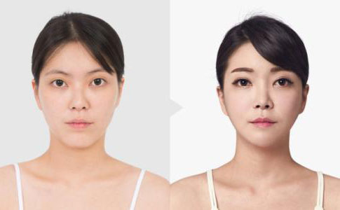 韓式埋線雙眼皮多久恢復(fù)自然？