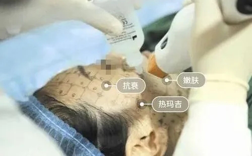牙齒矯正期間是不能做熱瑪吉嗎？