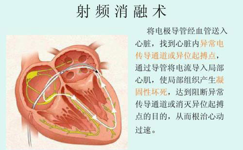 射頻祛眼袋效果怎么樣？