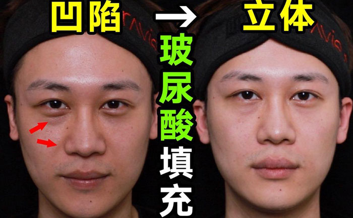 淚溝填充用什么方法最好？淚溝填充手術(shù)大約多少錢？