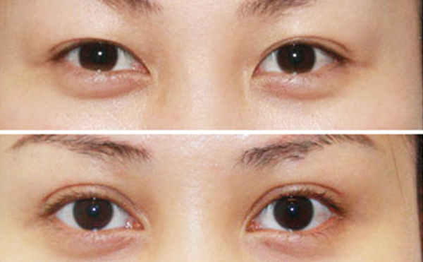 內(nèi)雙做雙眼皮是什么價(jià)格？效果怎么樣？