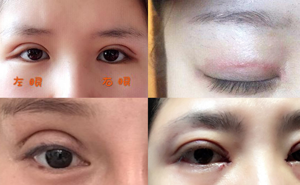 雙眼皮術后為什么不自然?怎樣避免肉條感?