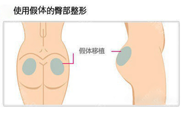假體豐臀多少錢？假體豐臀效果是永久的嗎？