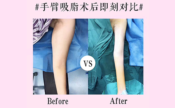 手臂吸脂會(huì)反彈嗎？