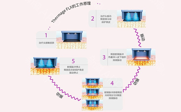 電波拉皮怎么去除魚尾紋？