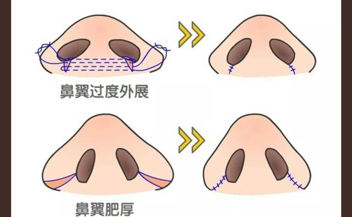 鼻頭肥大怎么改善？鼻頭肥大矯正術(shù)多少錢？