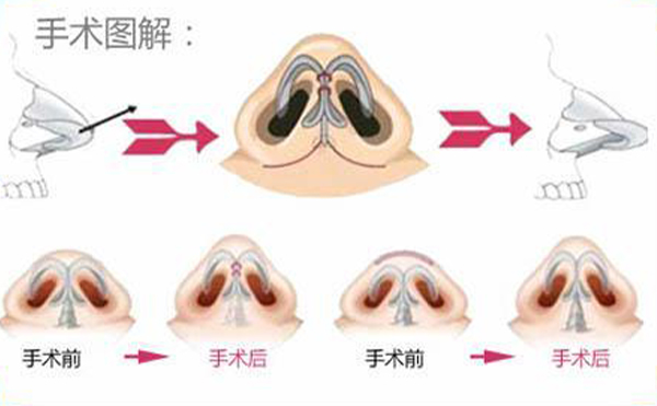 鼻翼縮小手術過程