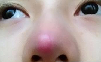 術(shù)后鼻頭發(fā)紅是隆鼻手術(shù)失敗了嗎？該怎么處理？