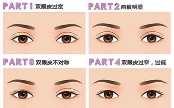 雙眼皮失敗有哪些明顯表現(xiàn)？修復(fù)成功率大嗎？