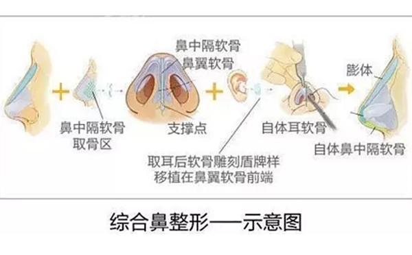 鼻綜合整形的效果怎么樣？鼻綜合手術(shù)安全嗎？