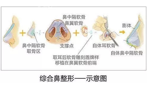 為什么都建議做鼻綜合手術(shù)？