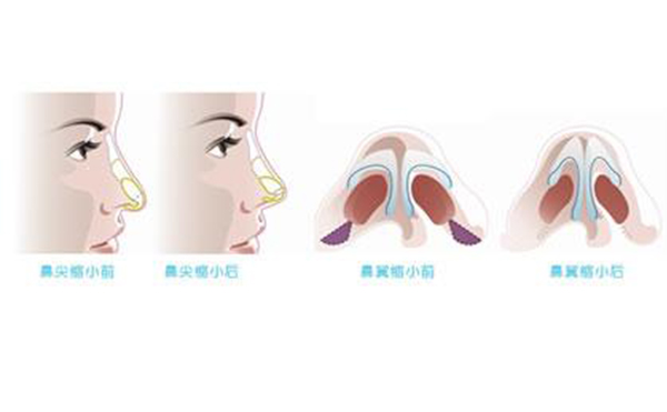 鼻翼縮小整形安全嗎？術(shù)后會不會影響呼吸