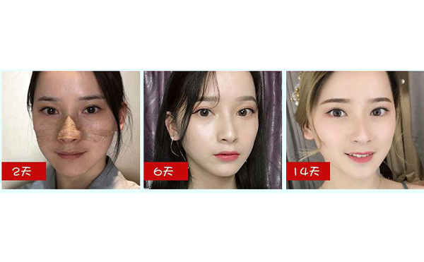全肋鼻和半肋鼻有什么區(qū)別？做全肋好還是半肋好