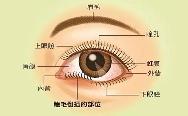 倒睫有什么危害?倒睫手術(shù)要多少錢(qián)?