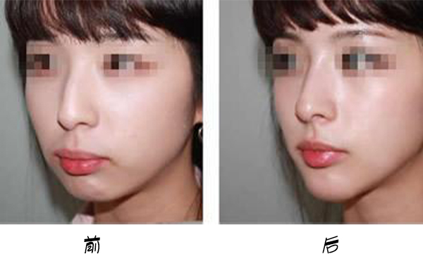 箭鼻是怎么出現(xiàn)的?箭鼻矯正是如何操作的？