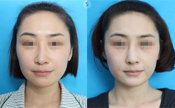 做歪鼻矯正手術大概需要多少錢?受哪些方面影響?