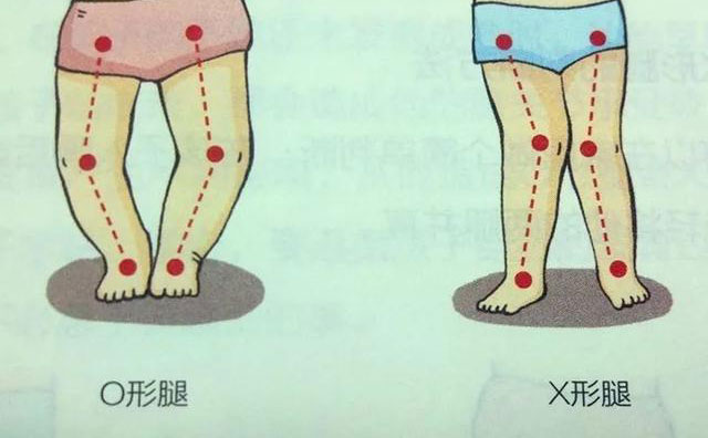 羅圈腿怎樣矯正？羅圈腿手術(shù)矯正多少錢？